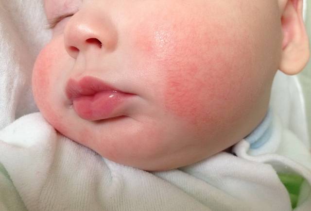 Аллергия на коже у ребенка