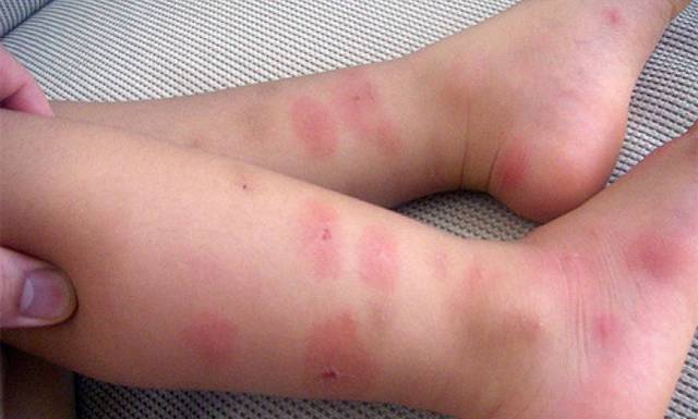 Аллергия на укусы комаров у детей