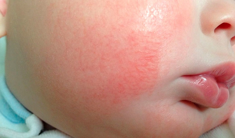 Атопический дерматит у грудного ребенка, симптомы и лечение