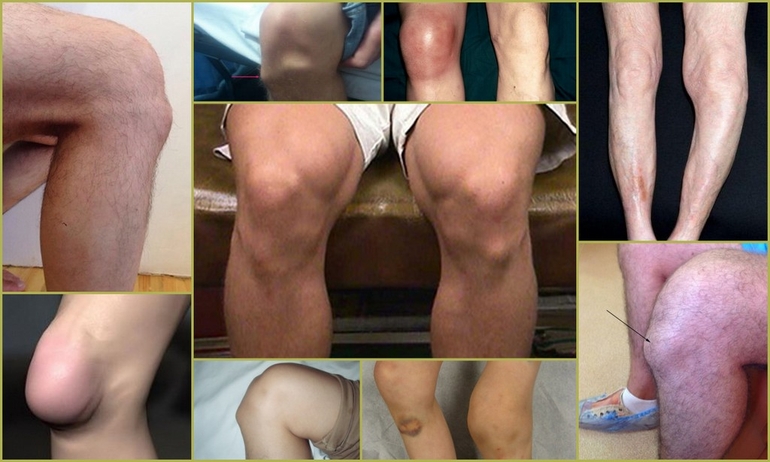 Болезнь коленного сустава (Шляттера) у подростка
