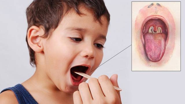 Советы Комаровского красное горло у ребенка, чем лечить?