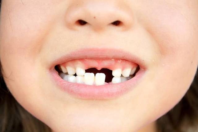 Какие молочные зубы выпадают у детей схема