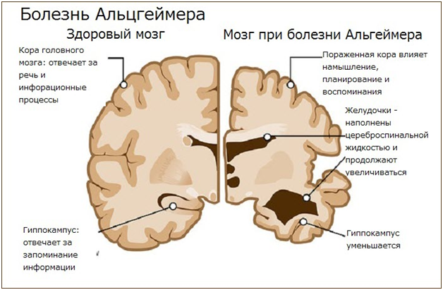 Мозг при болезни Альцгеймера