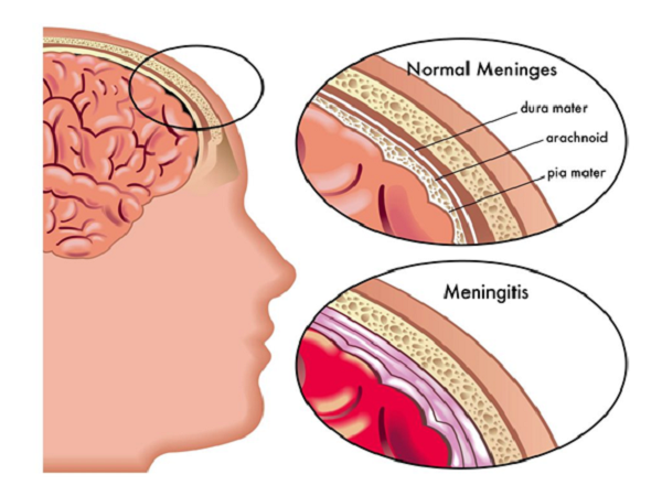 Мозг при менингите