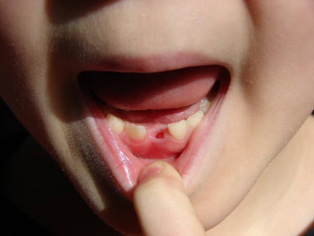 Пульпит зуба у детей